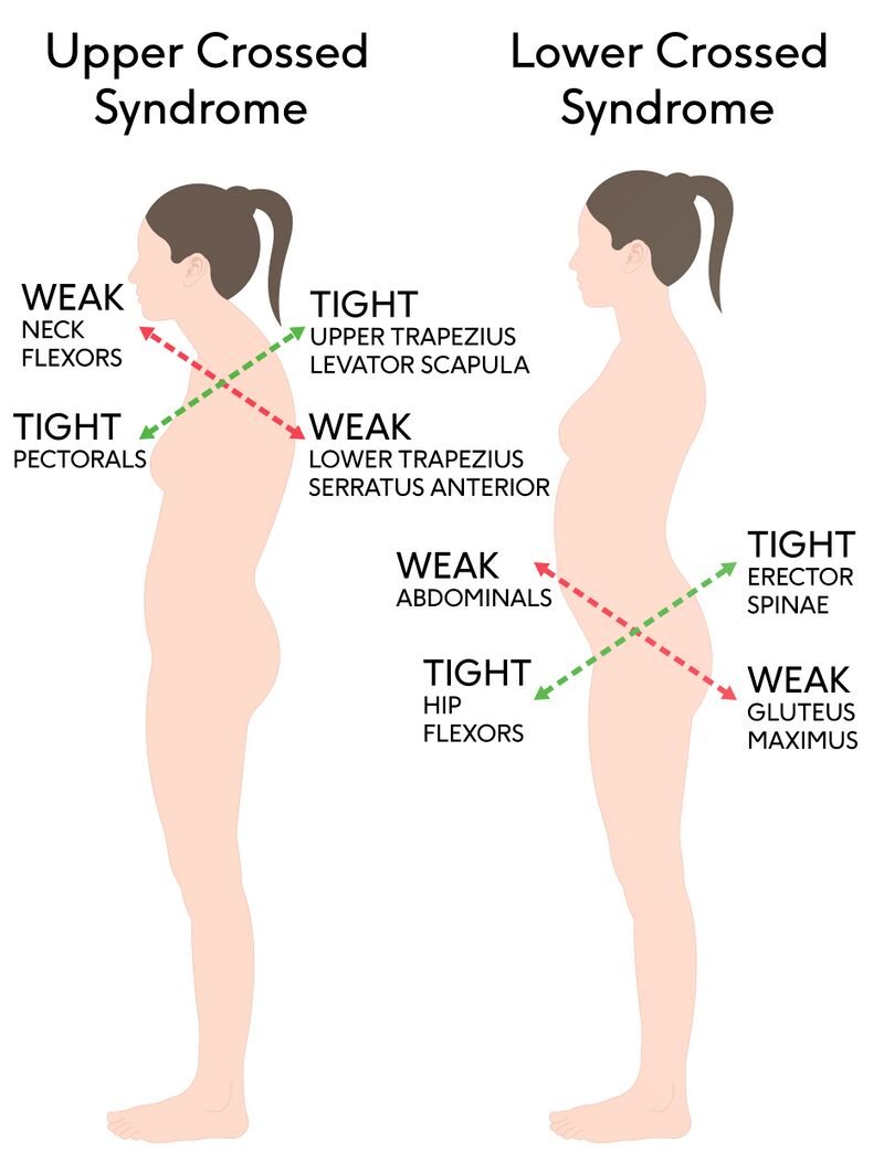 Upper Crossed pattern: tight chest, weak back