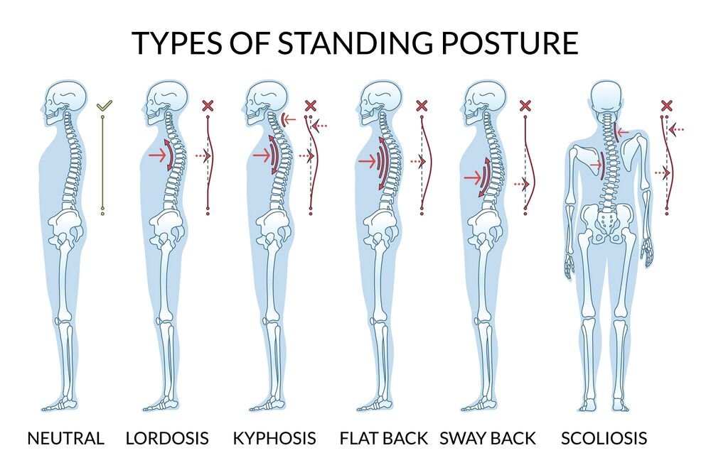 Common posture types